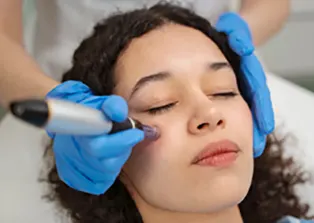 Micro needling - Facial Clinic Chelsea
