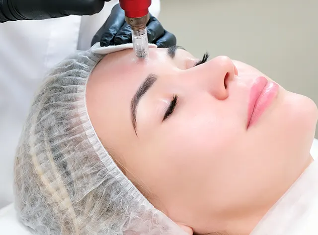 Best Micro needling treatment in London