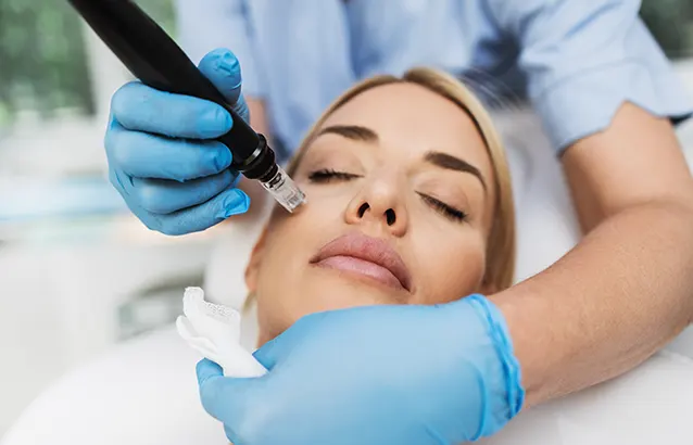 microneedling treatment London