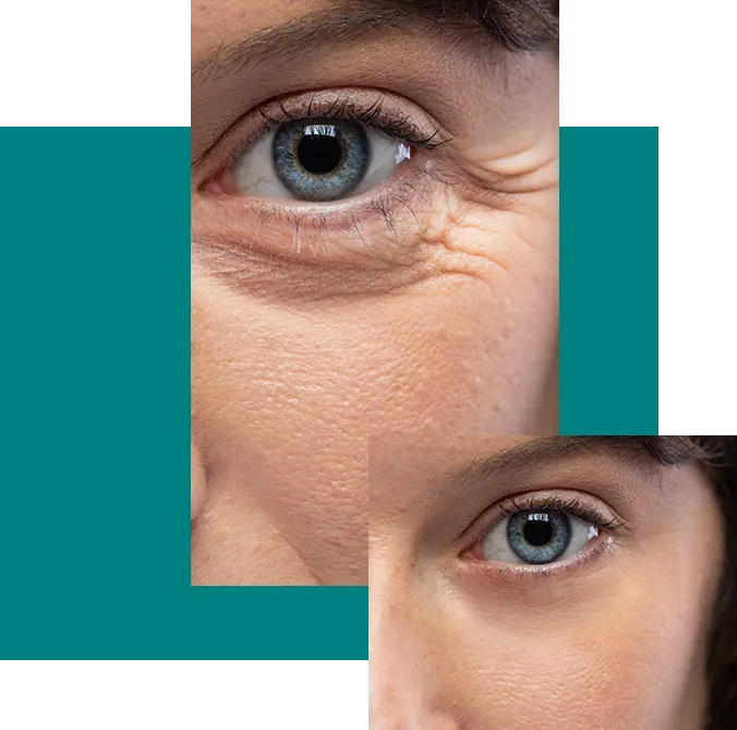 Radio Frequency Skin Treatment in London