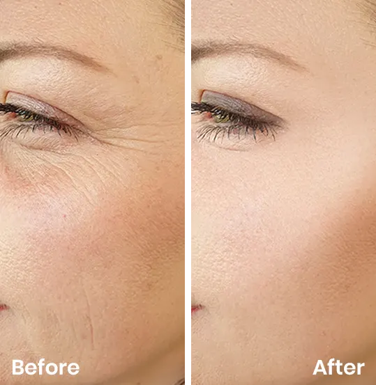 Wrinkle injections in London